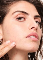 thực-phẩm-có-thể-gây-mụn-không